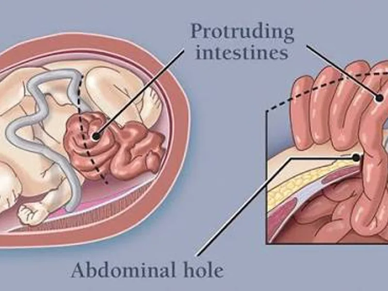 Female Gastroschisis Repair Surgery in Ranchi