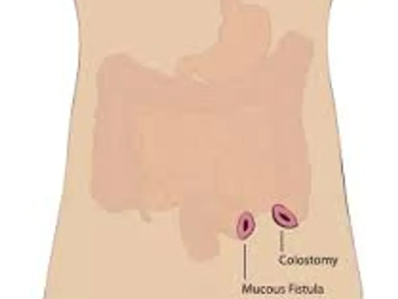Female Imperforate Anus High Anomaly Closure of Colostomy in Ranchi