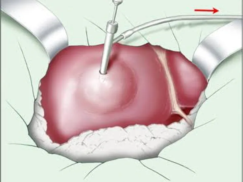 Female Hydatid Cyst Surgery in Ranchi