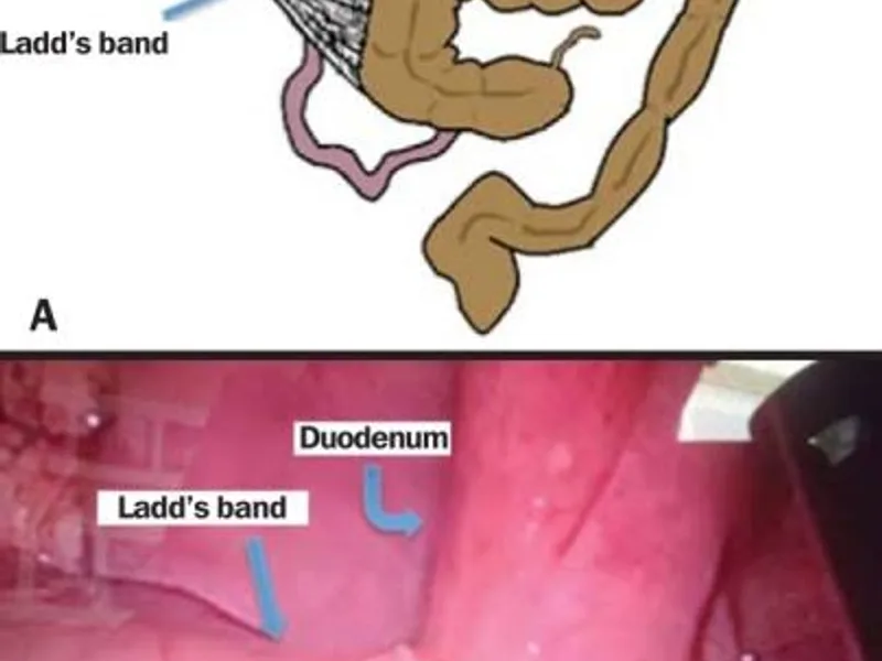 Female Malrotation of Gut Surgery in Ranchi