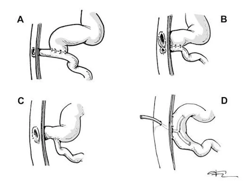 Female Meconium Ileus Operation Surgery in Ranchi