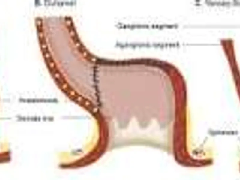 Female Abdominal Perineal Pull Through (Hirschsprung Disease) Surgery in Ranchi