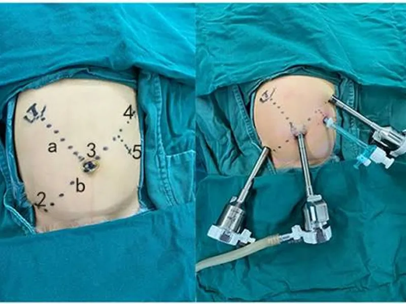 Female Choledochal Cyst Operation Surgery in Ranchi