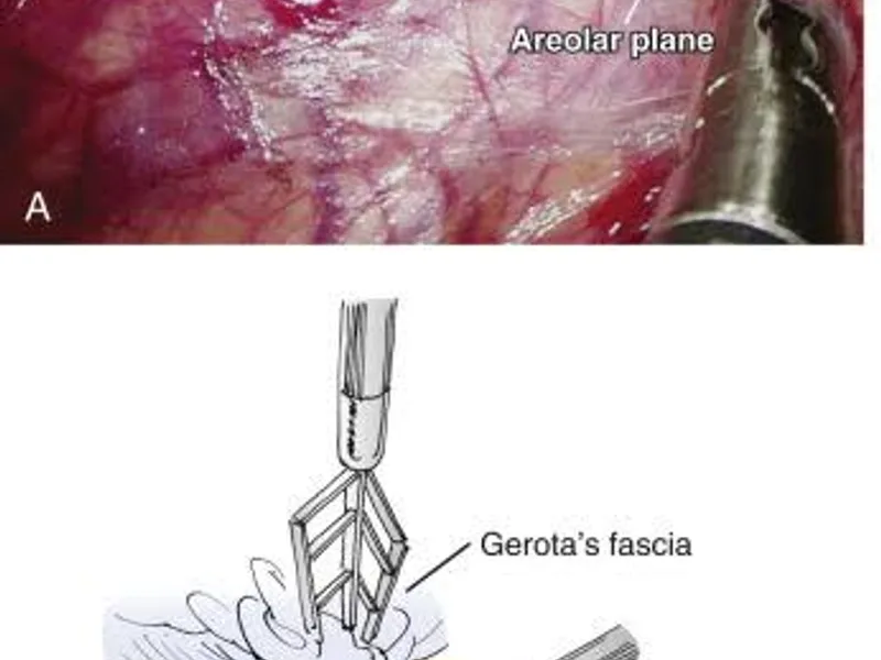 Female Nephrectomy for Pyonephrosis Surgery in Ranchi