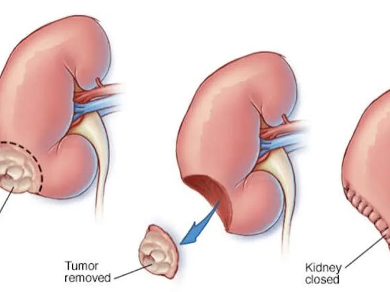 Female Nephrectomy for Wilms Tumour Surgery in Ranchi