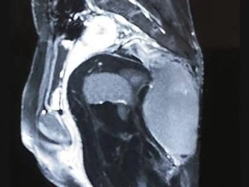 Female Sacrococcygeal Teratoma Excision Surgery in Ranchi