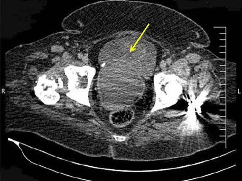 Female Rhabdomyosarcoma Wide Excision Surgery in Ranchi