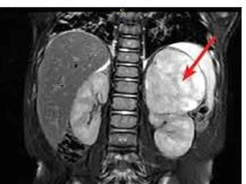 Female Neuroblastoma Total Excision Surgery in Ranchi