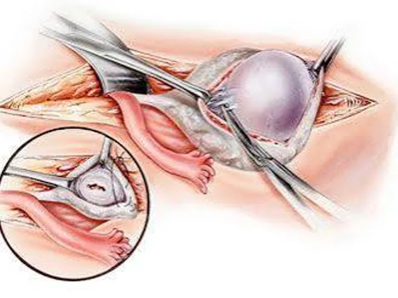 Female Neuroblastoma Debulking Surgery in Ranchi