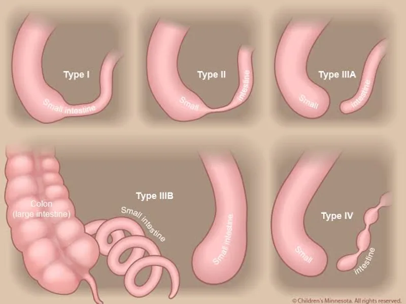 Female Congenital Atresia Stenosis Small Intestine Surgery in Ranchi