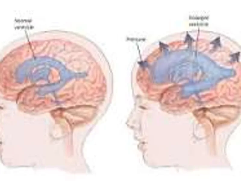 Female VP Shunt Surgery in Ranchi