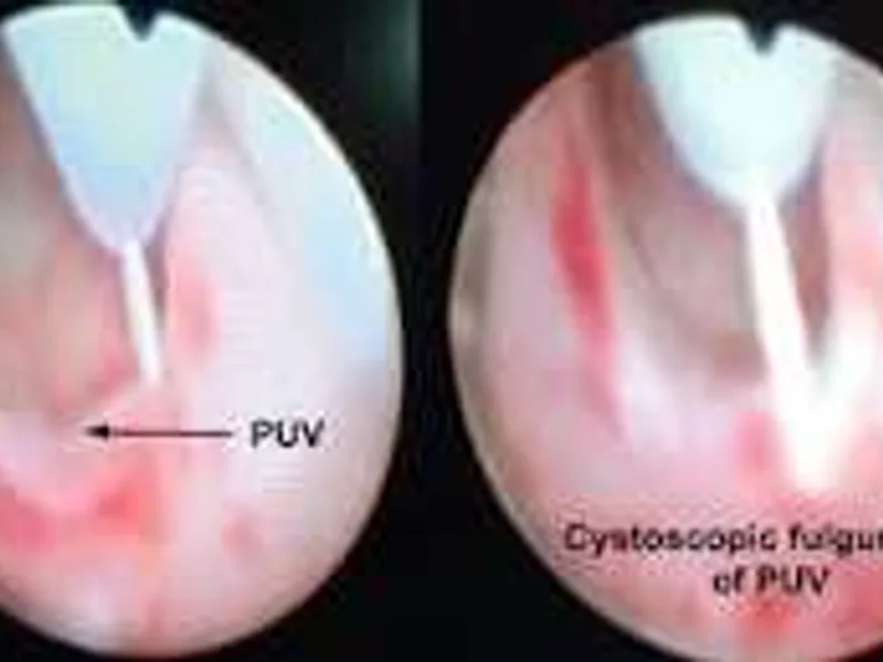 Female Cystoscopic PU Valve Fulguration Surgery in Ranchi