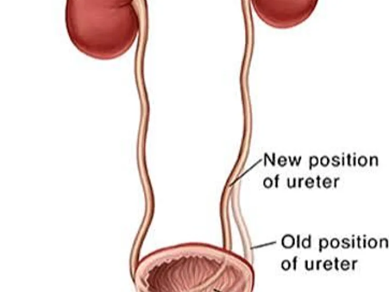 Female Ureteric Reimplantation Unilateral Surgery in Ranchi