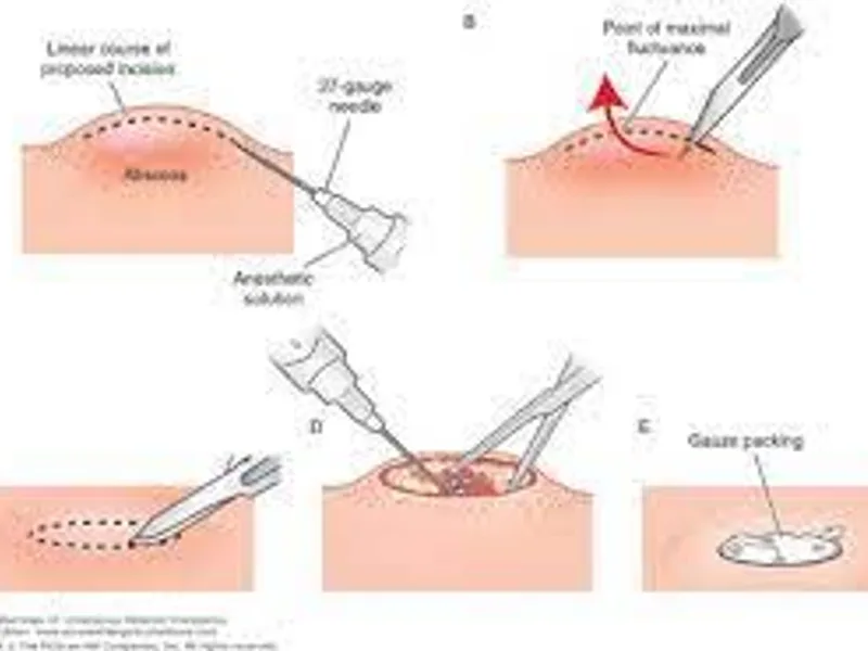 Female Incision & Drainage (I&D) Surgery in Ranchi
