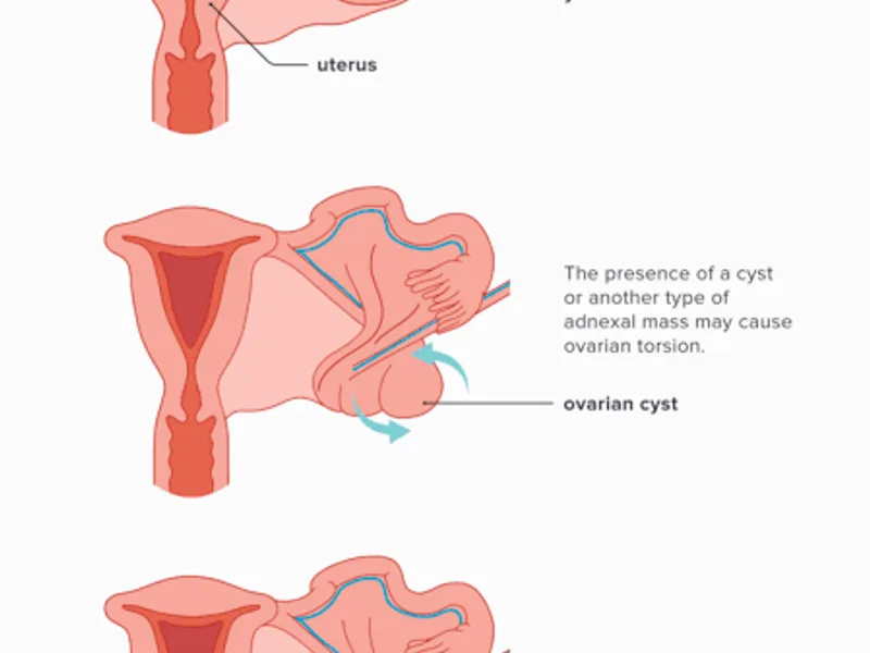 Female Torsion of Ovary Operation in Dhanbad