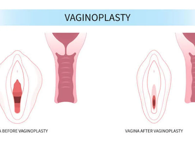 Female Vaginoplasty Reconstruction Surgery in Dhanbad