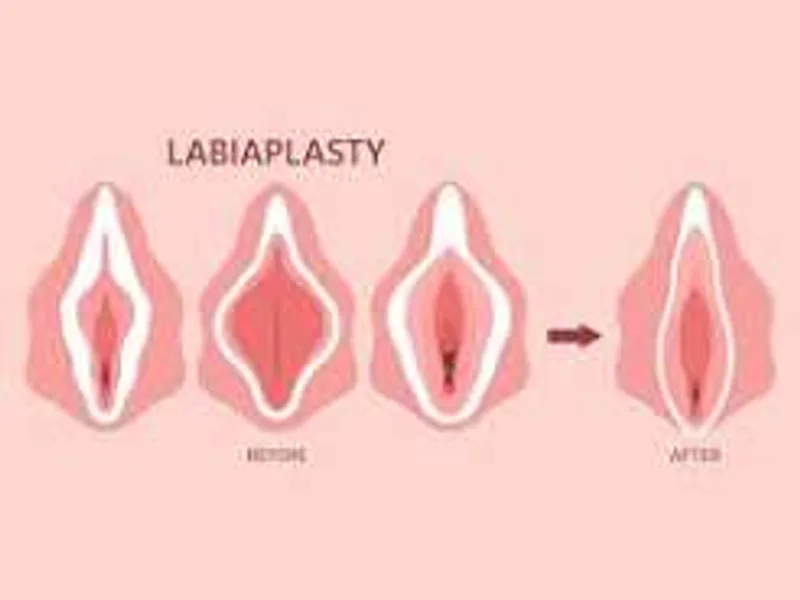 Female Labiaplasty Surgery in Dhanbad