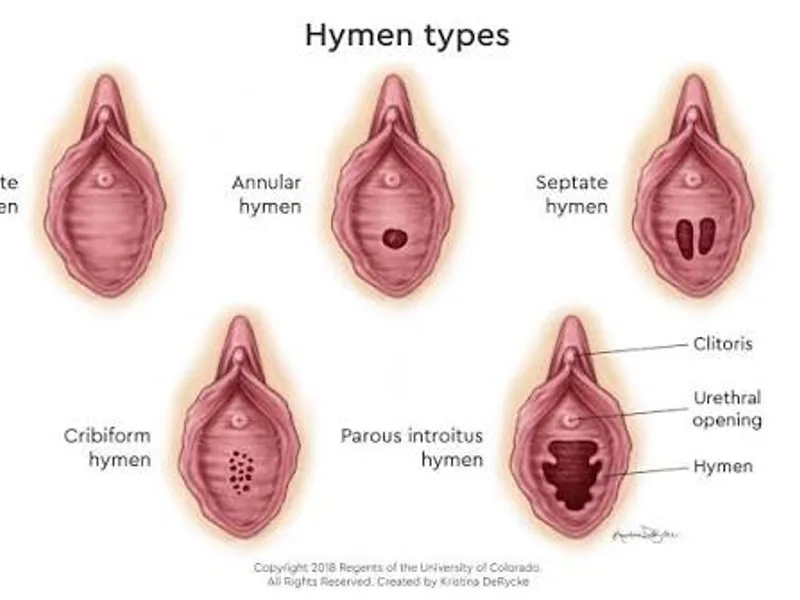 Female Imperforate Hymen Excision Surgery in Dhanbad