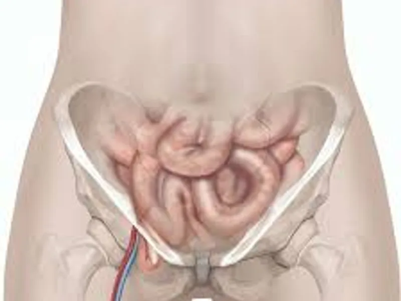 Female Femoral Hernia Repair Surgery in Dhanbad
