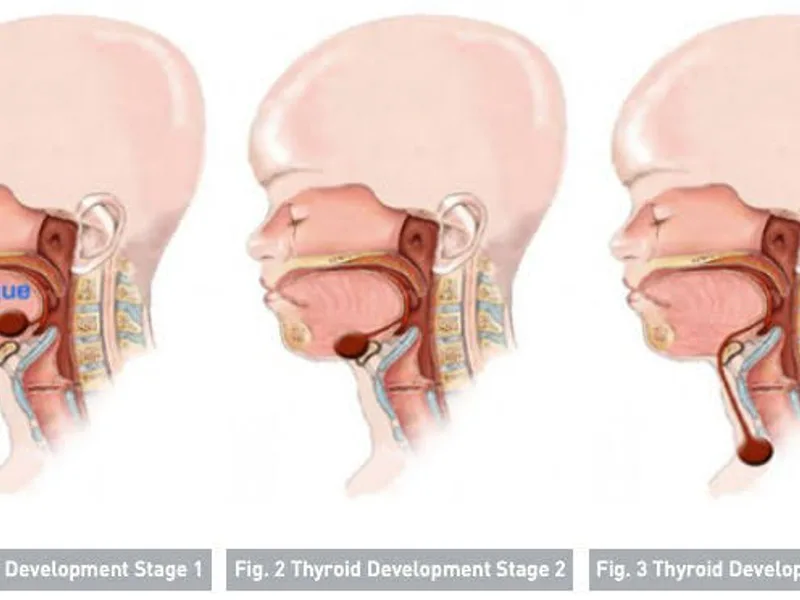 Female Excision of Thyroglossal Duct Cyst Surgery in Dhanbad