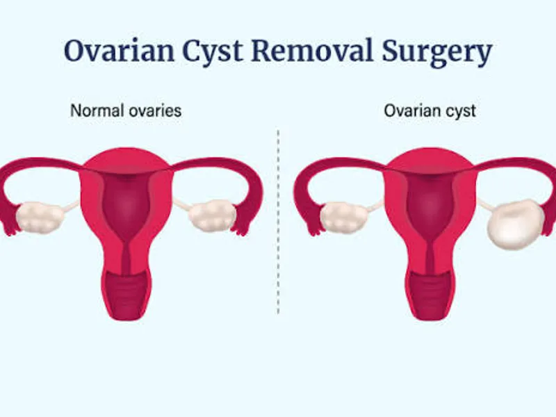 Female Excision of Cyst Surgery in Dhanbad