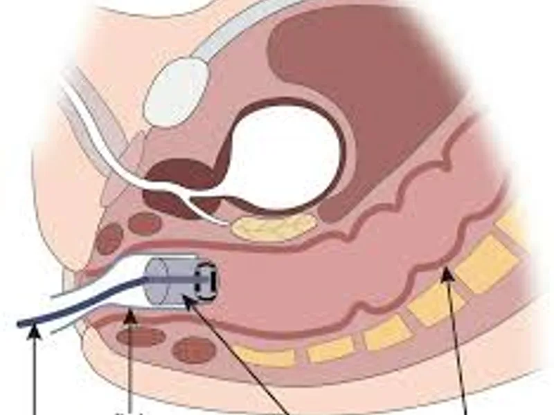 Female Removal of Foreign Body Surgery in Dhanbad
