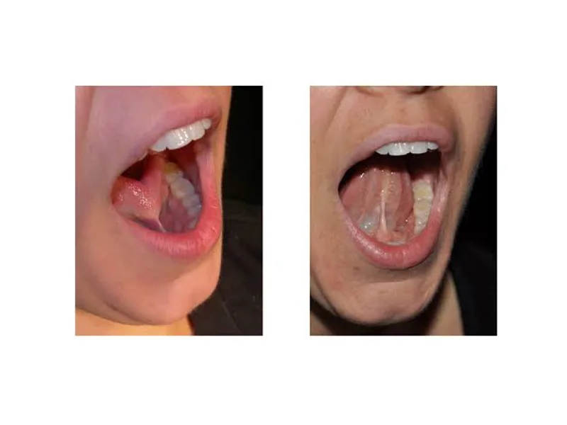 Female Tongue Tie Excision Surgery in Dhanbad