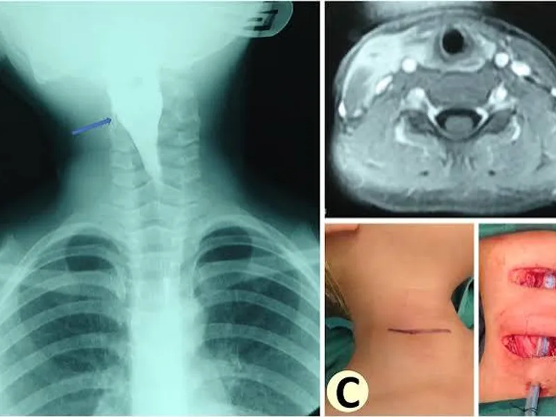 Female Excision of Branchial Cyst Surgery in Dhanbad