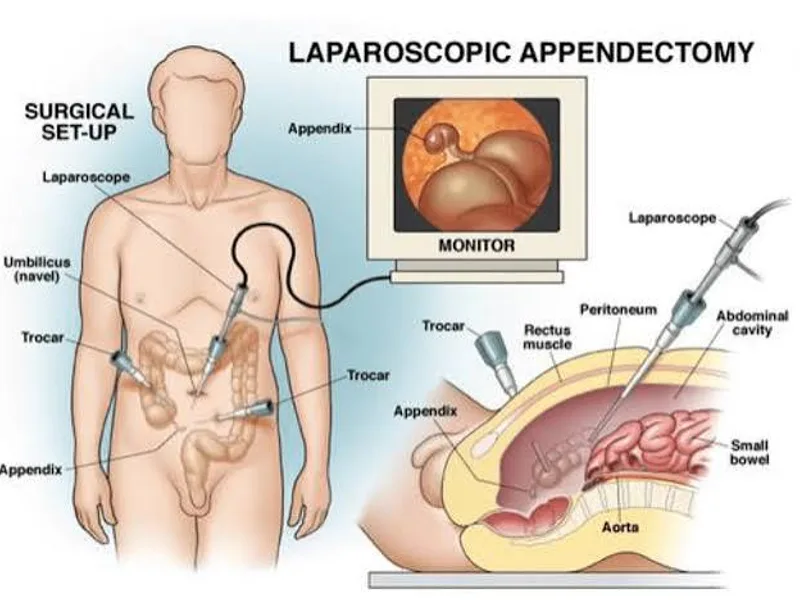 Female Open Appendectomy Surgery in Dhanbad