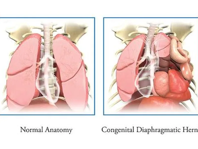 Female Diaphragmatic Hernia Repair Surgery in Dhanbad