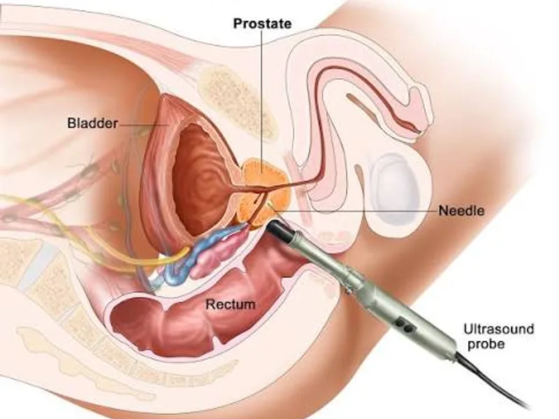 Female Rectal Biopsy Surgery in Dhanbad