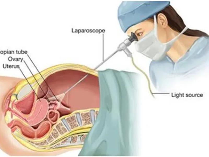 Female Laparoscopic Abdominal Cyst Operation in Dhanbad