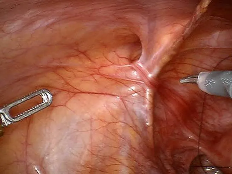 Female Omphalocele First Stage Hernia Repair Surgery in Dhanbad
