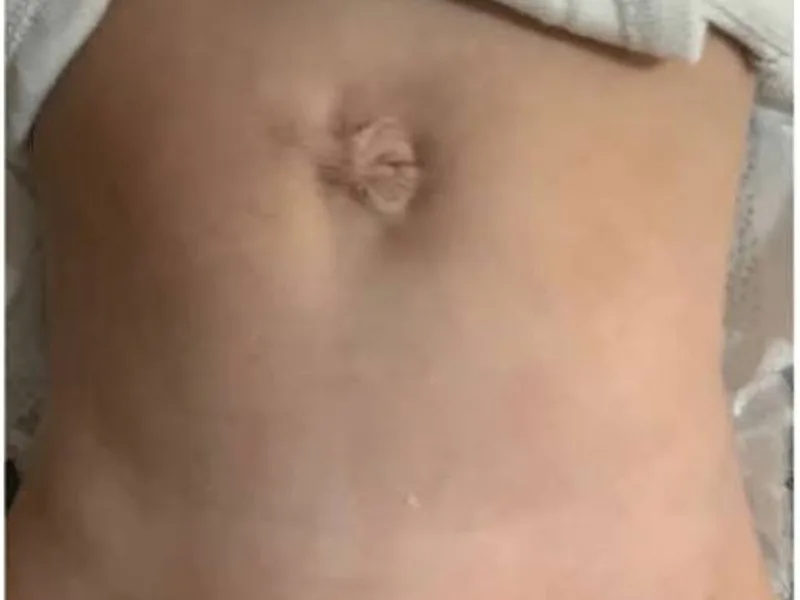 Female Gastroschisis Repair Surgery in Dhanbad