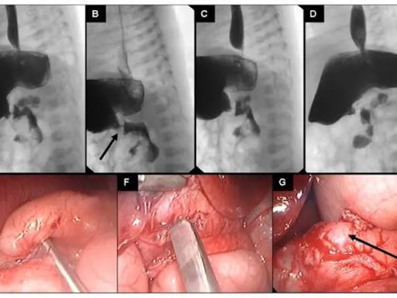 Female Congenital Pyloric Stenosis Operation in Dhanbad