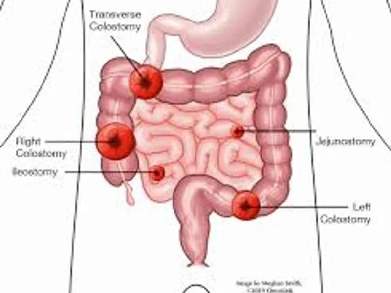 Colostomy Surgery in Dhanbad: A Complete Guide for Patients and Families
