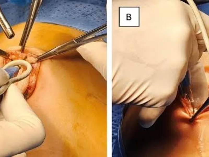 Female Intussusception Operation Surgery in Dhanbad