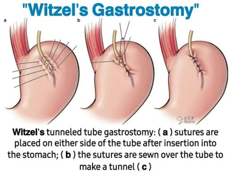 Female Esophagostomy Gastrostomy Surgery in Dhanbad