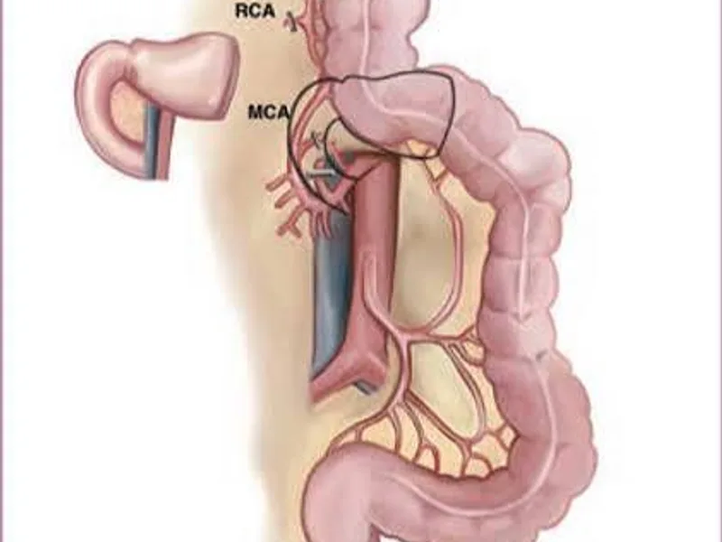 Female Colon Esophagus Replacement Surgery Dhanbad