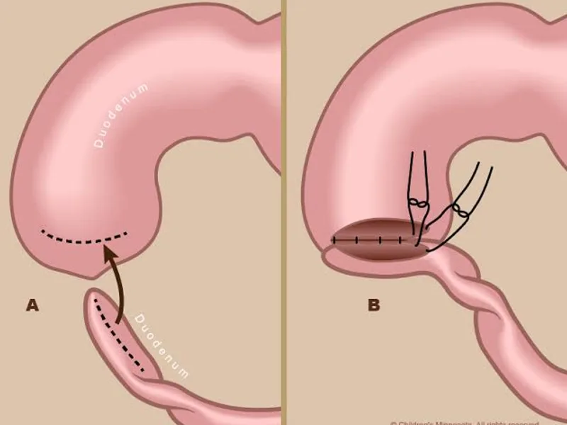 Female Duodenal Atresia Operation Surgery in Dhanbad