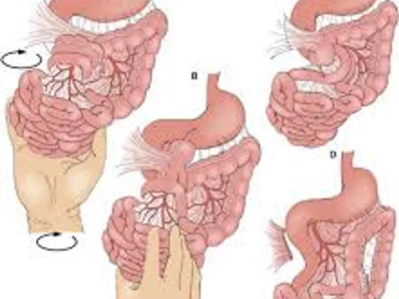 Female Malrotation of Gut Surgery in Dhanbad