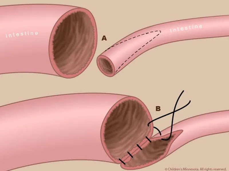 Female Intestinal Atresia Surgery in Dhanbad