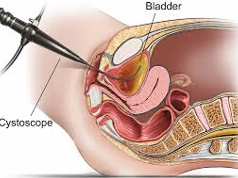 Female Cystoscopy Surgery in Dhanbad