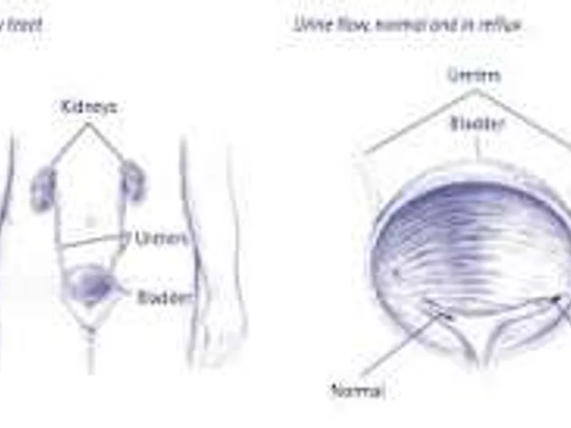 Female Ureteral Reimplantation Surgery for VUR in Dhanbad