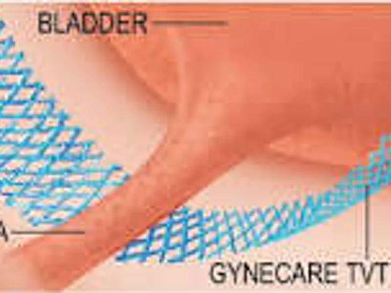 Female TVT Bladder Sling Surgery in Dhanbad