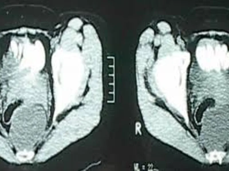 Female Sacrococcygeal Teratoma Excision Surgery Dhanbad