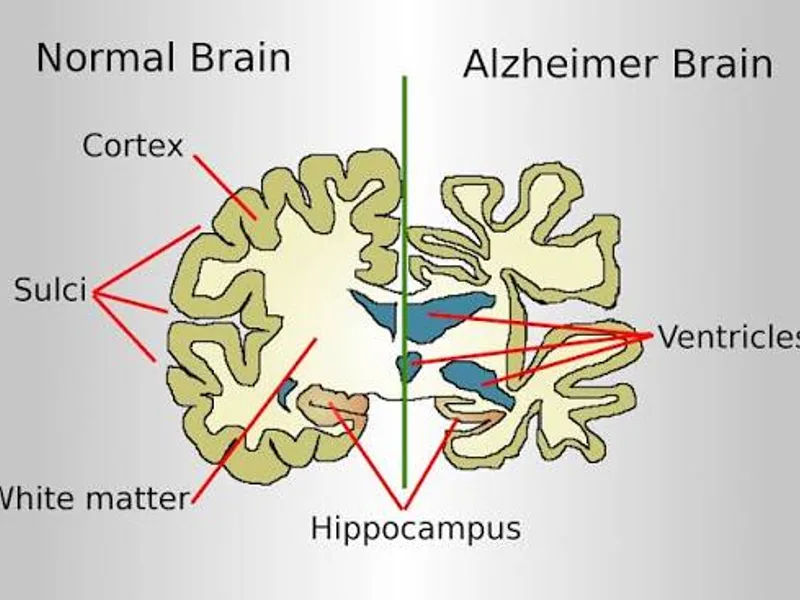 Alzheimer’s Disease: Symptoms, Stages & Treatment Guide