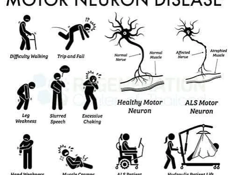 Motor Neuron Disease: Symptoms, Causes & Treatment