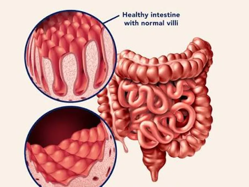 Celiac Disease: Symptoms, Causes, Treatment & Gluten-Free Living