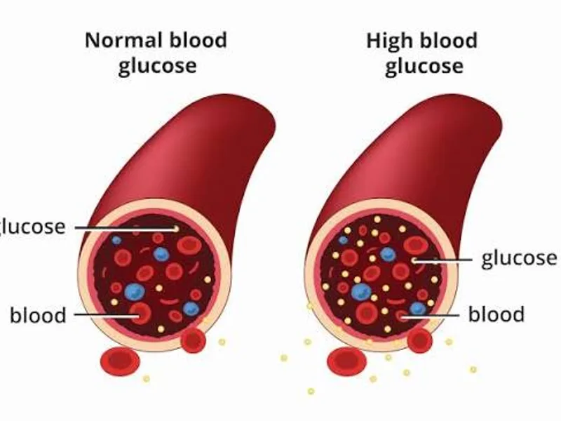 Type 2 Diabetes: Causes, Symptoms & Reversal Strategies